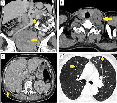 Case Report: Ectopic Adrenocortical Carcinoma in the Ovary